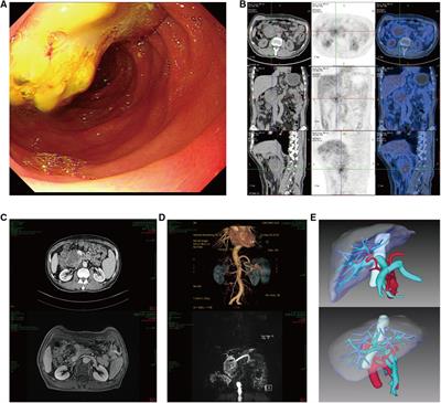 Successful pancreatoduodenectomy of de novo duodenal malignancy after orthotopic liver transplantation: A case report